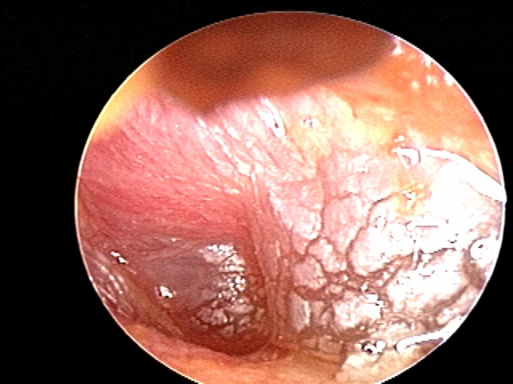 AOM, edematous membrane