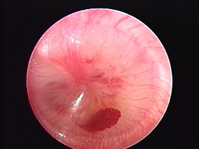 AOM, hemorrhage, opacification, air/fluid levels