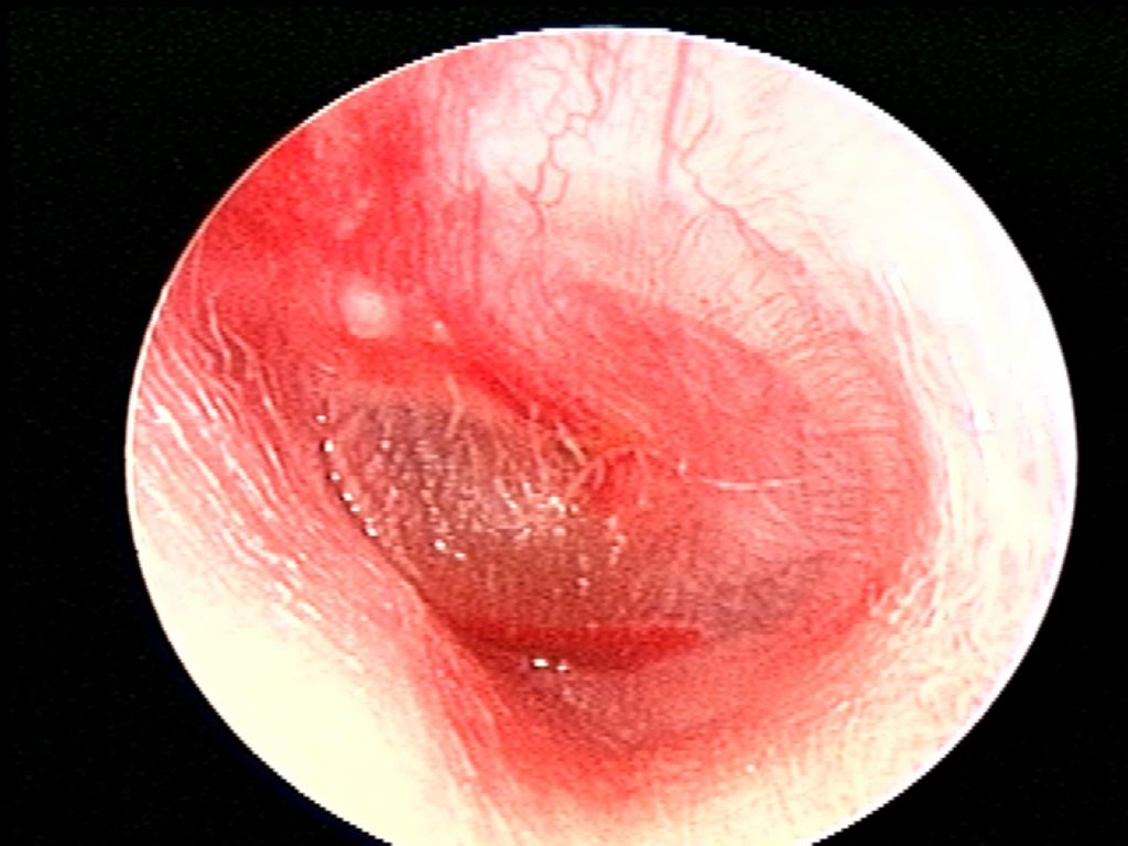 AOM, severe bulging