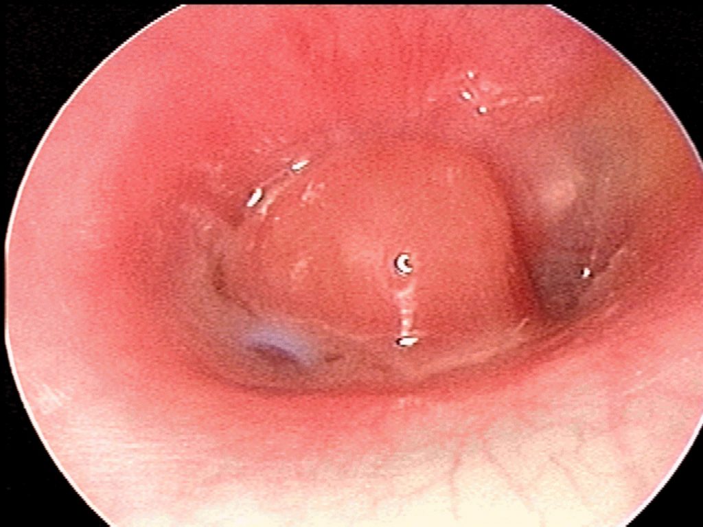 AOM, tube granulation