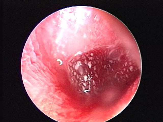 AOM with hemorrhagic bulla