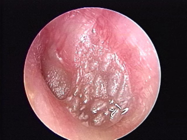 AOM with some cobblestoning with edema of tympanic membrane