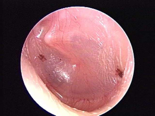 Healed AOM with hemorrhage