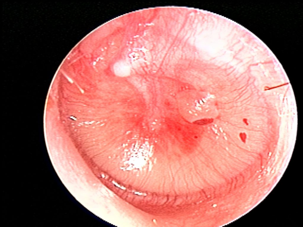 Hemmorrhagic bulla AOM