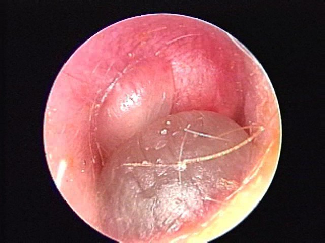 Massive bulla AOM