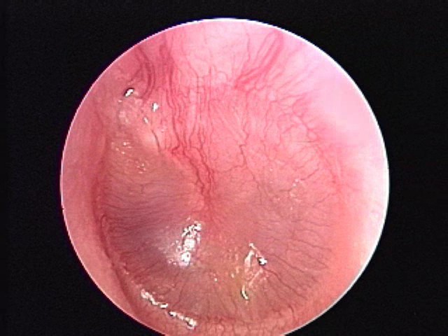 Mild or full bulging air bubble erythema AOM