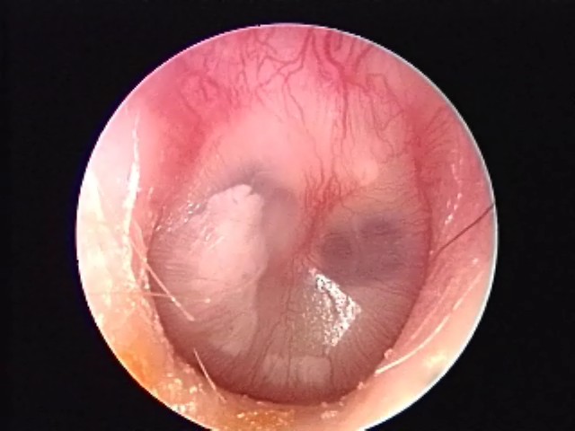 Mild bulging, bubbles, opaque fluid, tympanosclerosis
