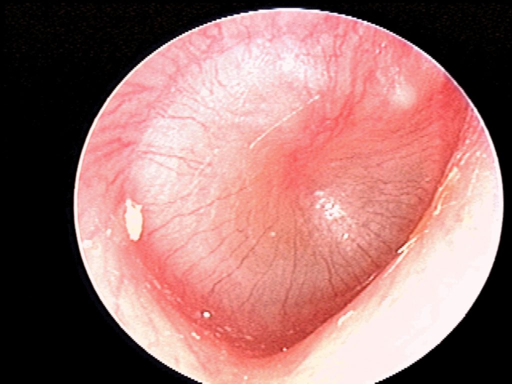 Moderate bulging AOM