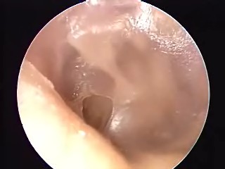 Perforated tympanic membrane