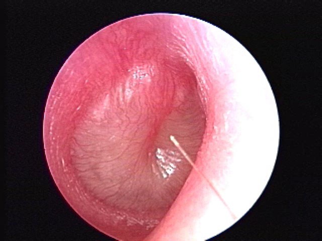 Severe Bulging AOM