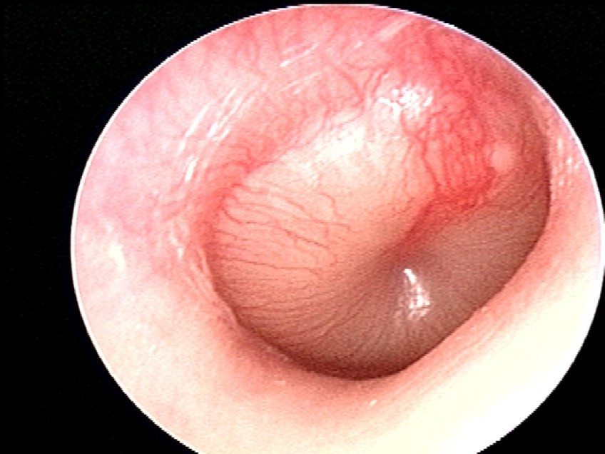 Severe bulging AOM