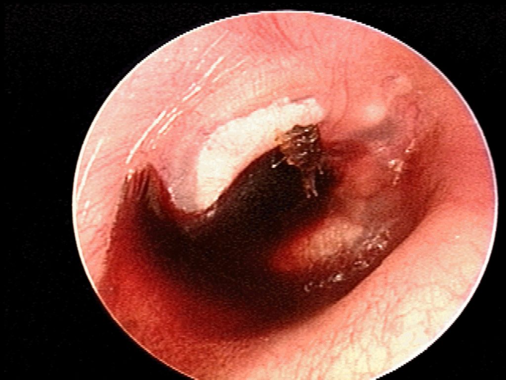 Traumatic hemmorhage