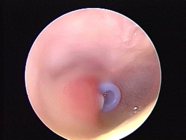 Tube granulation, erythema, AOM