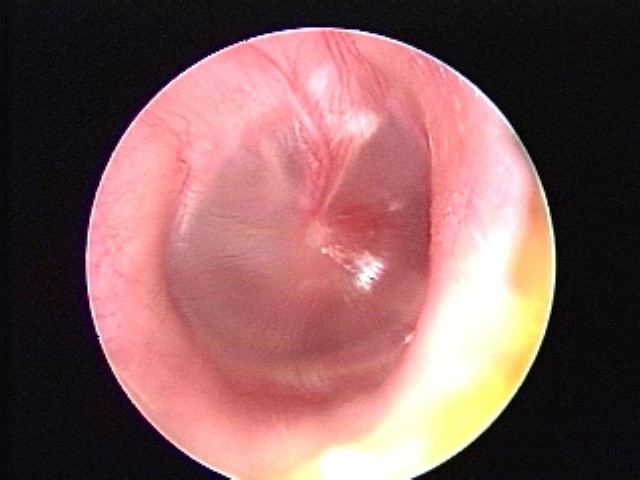Child with influenza virus and hyperemia, OME