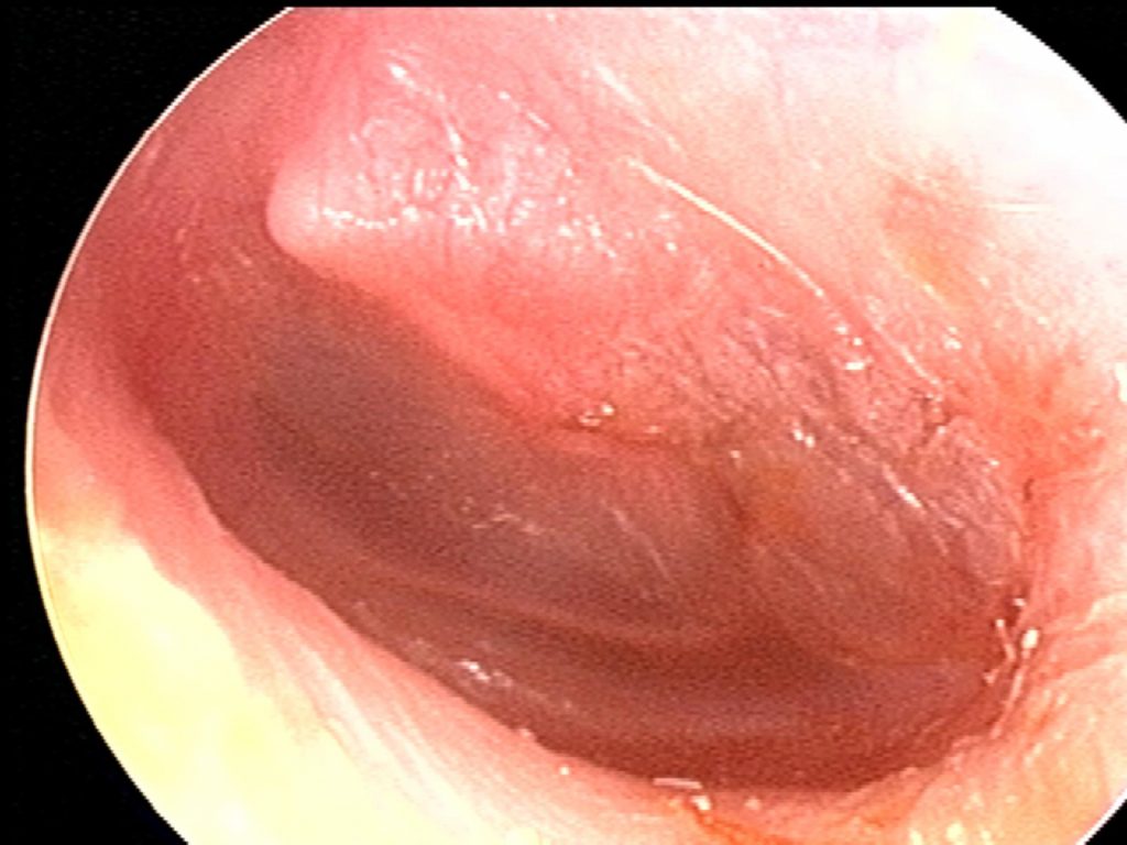 Clear fluid, retraction, hemorrhage, OME