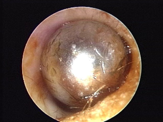 Foreign body in canal