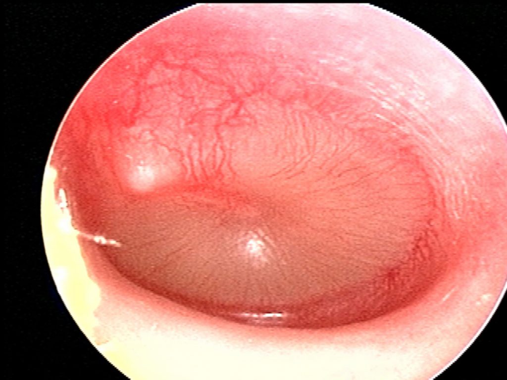 full or mild bulging erythema opaque fluid AOM