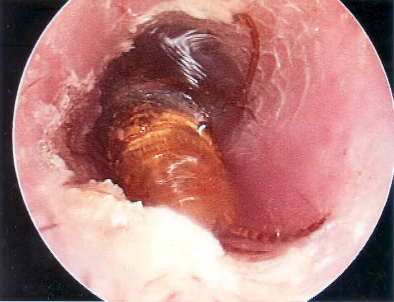 honey bee in ear canal