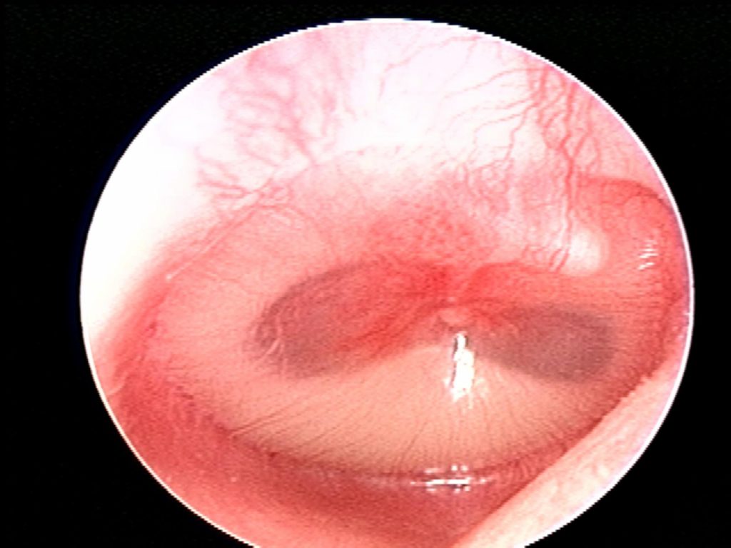 Mild bulging, air/fluid levels, marked erythema, AOM