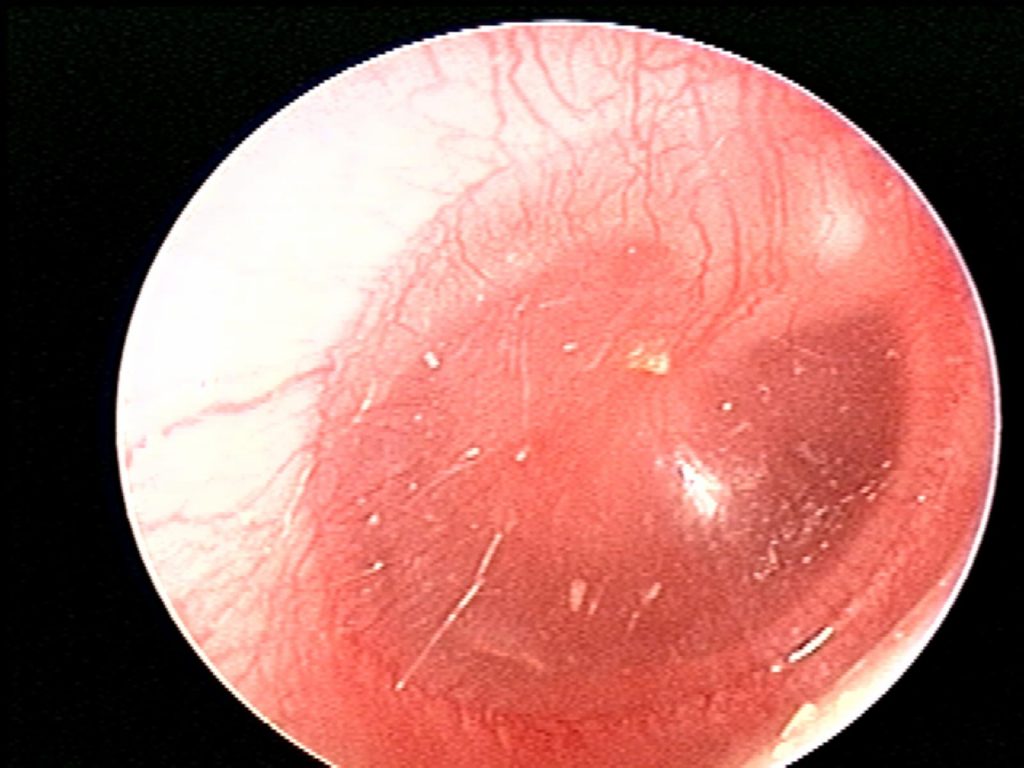 Opaque fluid in upper anterior quadrants