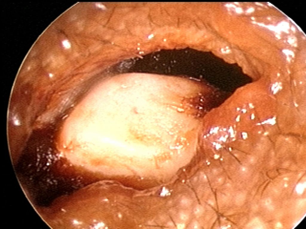 Pebble in ear canal