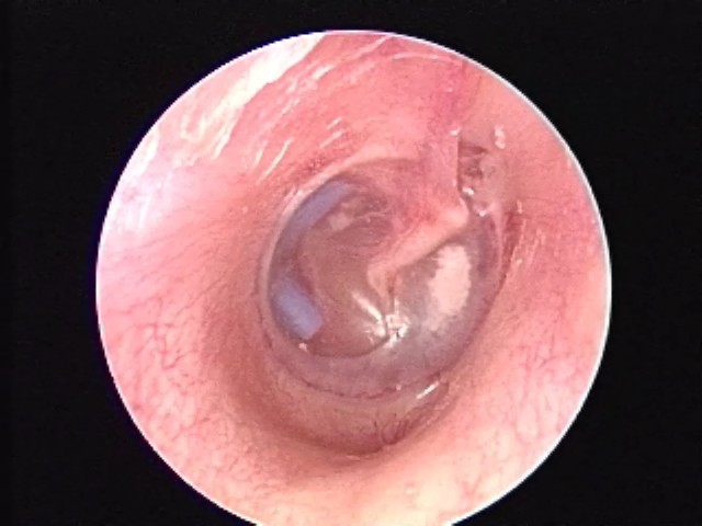 Pressure equalizing tube in retraction pocket