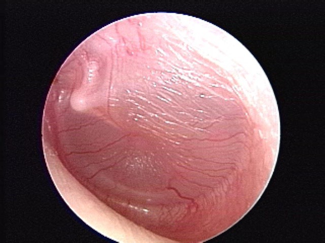 Prominent vasculature, retraction, opaque fluid, air/fluid level