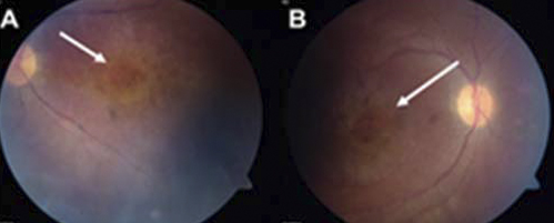 Diseased areas of the retinas of a patient with LCA16.