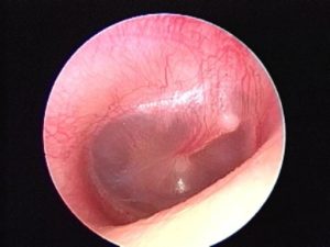 Mild erythema only, No effusion, myringitis only