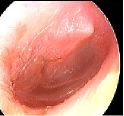 Otitis Media with Effusion Mild erythema, air/fluid level clear fluid, no bulging, retracted TM with prominent short process of the malleolus