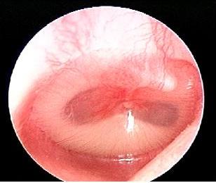 AOM vs. OME Uncertainty Mild/moderate bulging, full opacification, air fluid level or air bubble(s), intense erythema