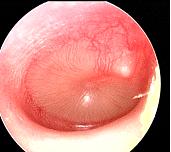 AOM vs. OME Uncertainty Moderate bulging complete effusion and opacification (no bubbles) intense erythema