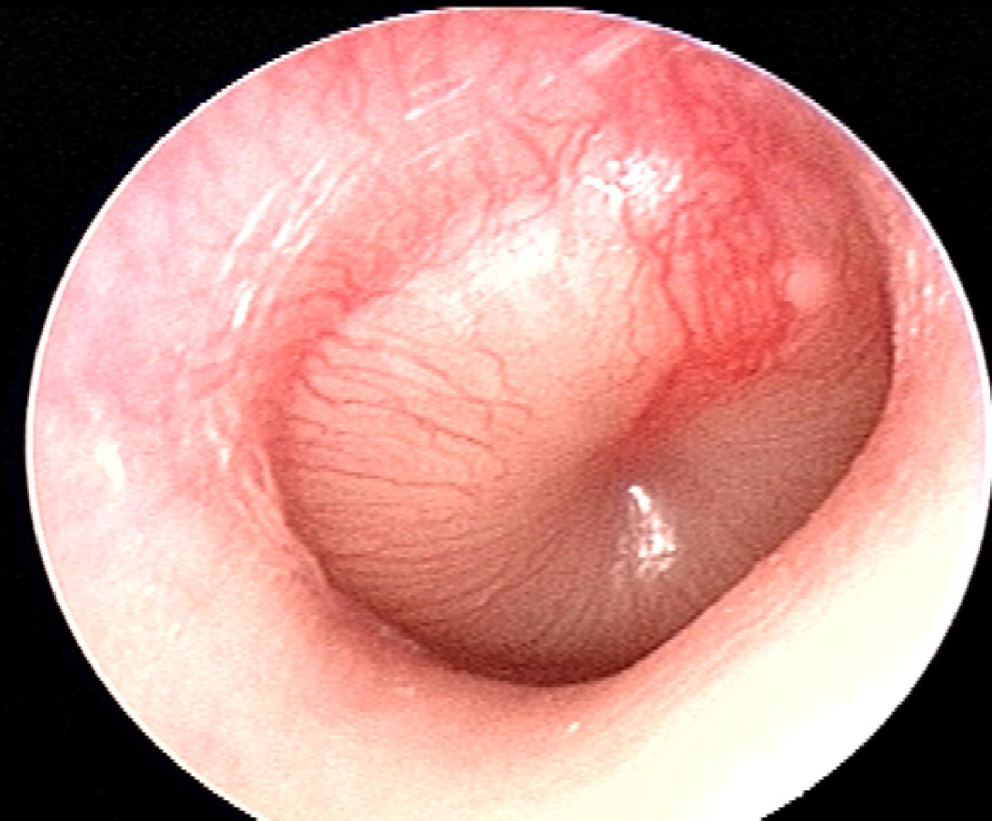 Acute Otitis Media Bulging rounded doughnut appearance of tympanic membrane, moderate