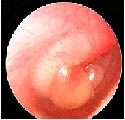 Acute Otitis Media Bulging, bulla, complete effusion, opacification, marked erythema