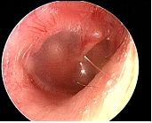 Otitis Media with Effusion Mild erythema, no opacification, retracted TM with prominent short process of the malleolus