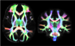 We use various quantitative MRI techniques to study the brain, including diffusion tractography (as seen here). 