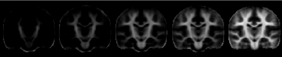 White matter development from 3 to 12 months of age