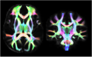 Scan of a human brain from Developing Brain Imaging Lab
