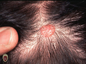 This nodule is a basal cell carcinoma on the scalp of a 23-year-old man