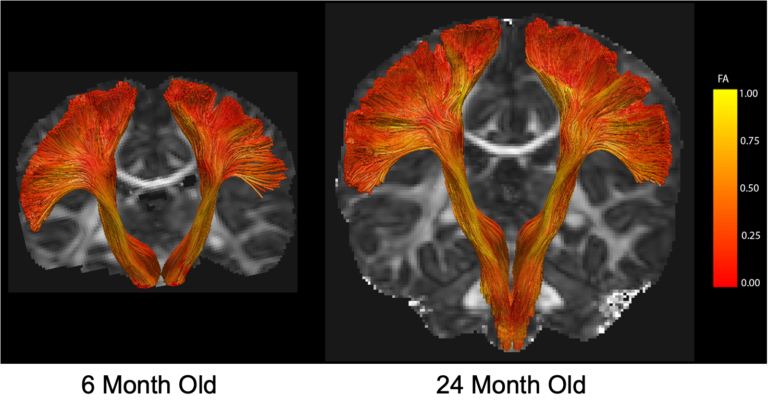 two MRI images of brains with colored lines highlighting fractional