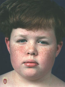 This 11-year-old boy's freckles (ephelides) are all macules.