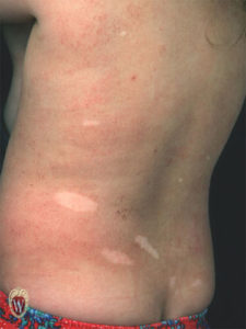 This 3-year-old girl with tuberous sclerosis has hypopigmented macules and patches.