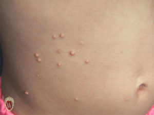 These are the papules of molluscum contagiosum in a 3-year-old girl.
