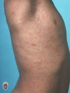 This nearly 5-year-old boy has hundreds of papules with an id reaction. An id reaction is a generalized hypersensitivity reaction on the skin to a local inflammatory lesion of the skin (e.g., a fungal infection).