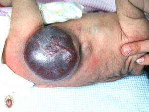 This 2-1/2 week old has a tumor that is a large AV malformation of her left flank.