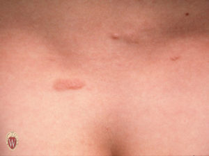The plaque on the left lumbosacral area of this 7-year-old boy is a shagreen plaque associated with tuberous sclerosis.