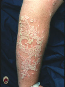 These are the extensive plaques of psoriasis covered with a characteristic silvery scale in an 18-year-old young man.