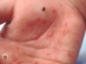 This 3-year-old boy has oval vesicles in his palm from hand, foot, and mouth disease.