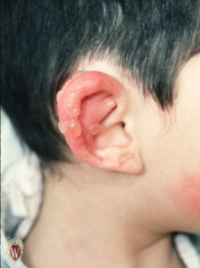 This 4-year-old boy has bullae on the pinna of his ear from a contact dermatitis.