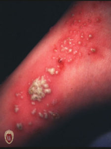 The pustules on the foot of this 15-year-old boy are caused by a grouup A beta-hemolytic streptococcus infection